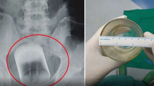 Dokter Temukan Gelas dalam Anus Lelaki Ini, Cara Mengeluarkannya? Dokter Temukan Gelas dalam Anus Lelaki Ini, Cara Mengeluarkannya?