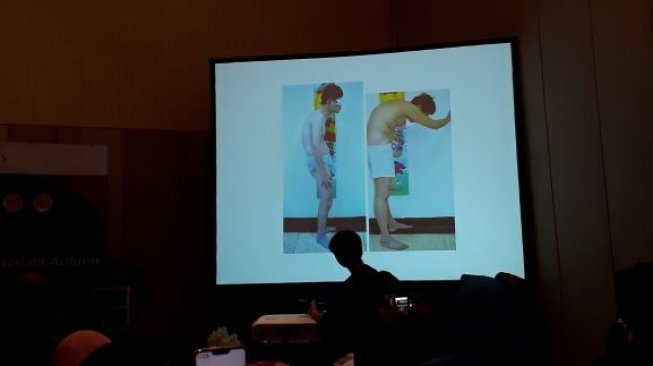Spondilitis Ankilosis Ancam Usia Muda, Ini Bahayanya Spondilitis Ankilosis Ancam Usia Muda, Ini Bahayanya
