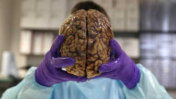 Mengenal Gejala Silent Stroke, Pembunuh Diam-diam Mengenal Gejala Silent Stroke, Pembunuh Diam-diam