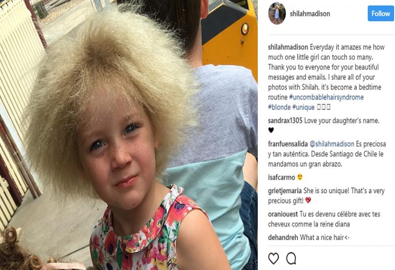 Kisah Shilah Yin, Penderita Sindrom Rambut yang Susah Disisir Kisah Shilah Yin, Penderita Sindrom Rambut yang Susah Disisir