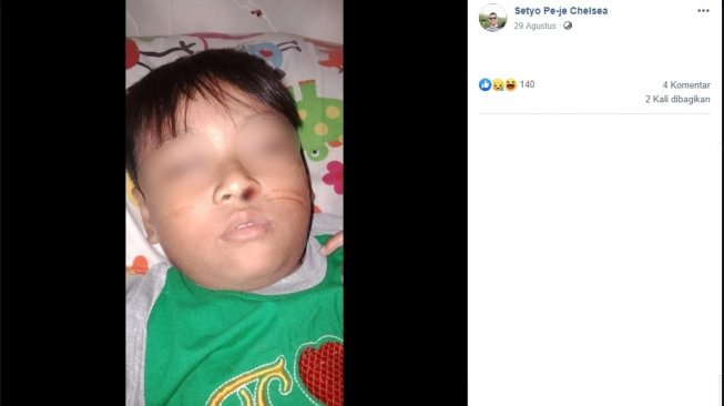 Viral Bocah Asal Solo Mimisan Sebulan, Ternyata Gara-gara Lintah! Viral Bocah Asal Solo Mimisan Sebulan, Ternyata Gara-gara Lintah!