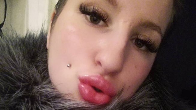Ingin Seksi, Wanita Ini 10 Kali Filler Bibir dan Habiskan Biaya Fantastis Ingin Seksi, Wanita Ini 10 Kali Filler Bibir dan Habiskan Biaya Fantastis