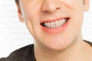 Cara Benar Merawat Gigi untuk Pengguna Kawat Gigi